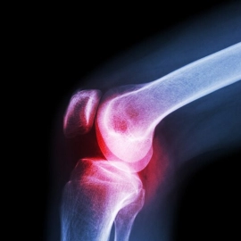 XL Knee Cap for Knee Support